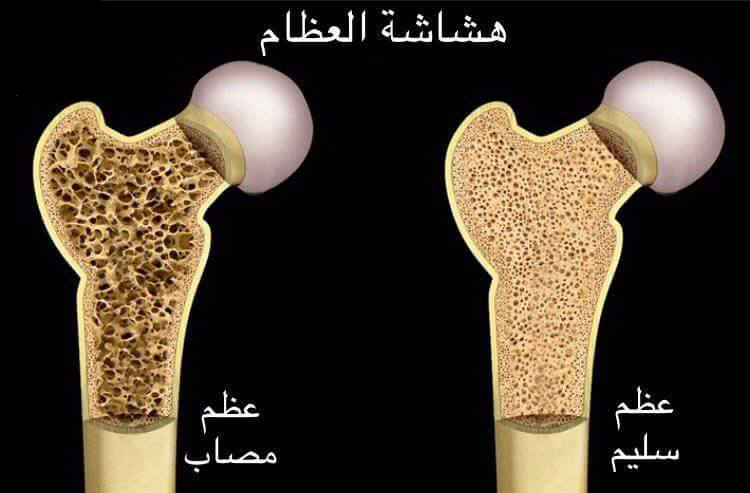 علاج هشاشة العظام في تركيا